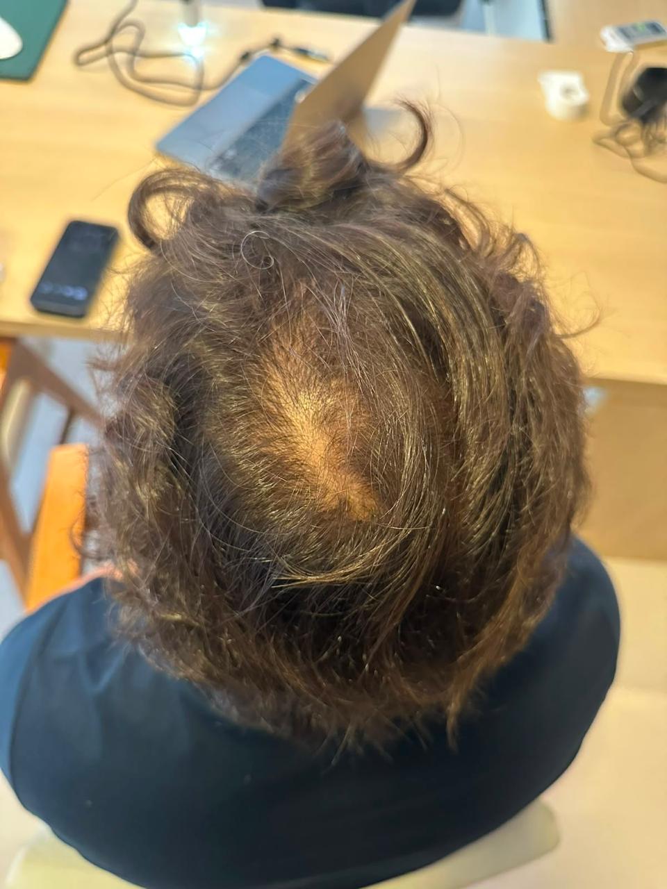 Antes do tratamento capilar — resultado 6